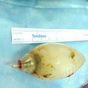 年轻男子肚子疼高烧 原因是以前吞了个灯泡-电竞游戏